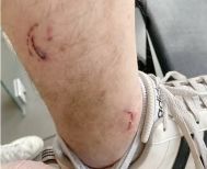 Για δάγκωμα αδέσποτων στους Αγίους Αναργύρους
