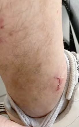 Για δάγκωμα αδέσποτων στους Αγίους Αναργύρους
