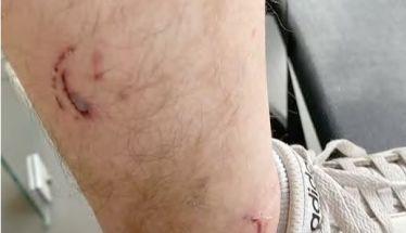 Για δάγκωμα αδέσποτων στους Αγίους Αναργύρους