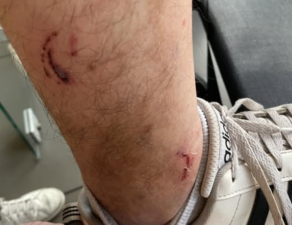 Ένα ακόμα περιστατικό από δάγκωμα αδέσποτων, στην περιοχή του πάρκου Αγίων Αναργύρων