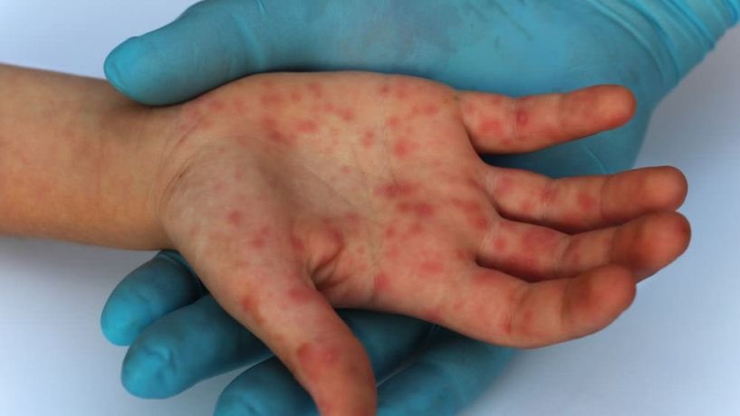 Διευκρινήσεις για αναφορές σε κρούσματα ιλαράς στην Ευρώπη